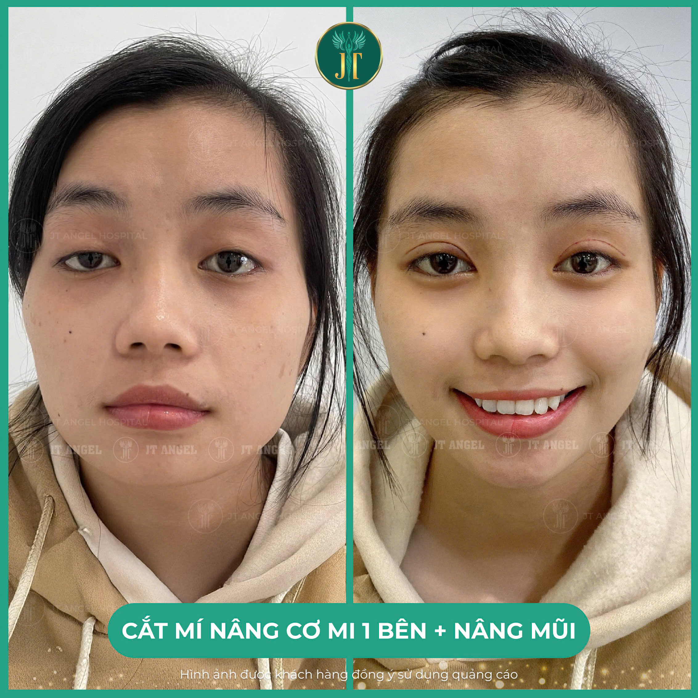 hinh-anh-truoc-sau-dieu-tri-sup-mi-minh-chung-ro-rang-cho-doi-mat-tre-hoa-can-doi-hoan-hao-va-day-suc-song