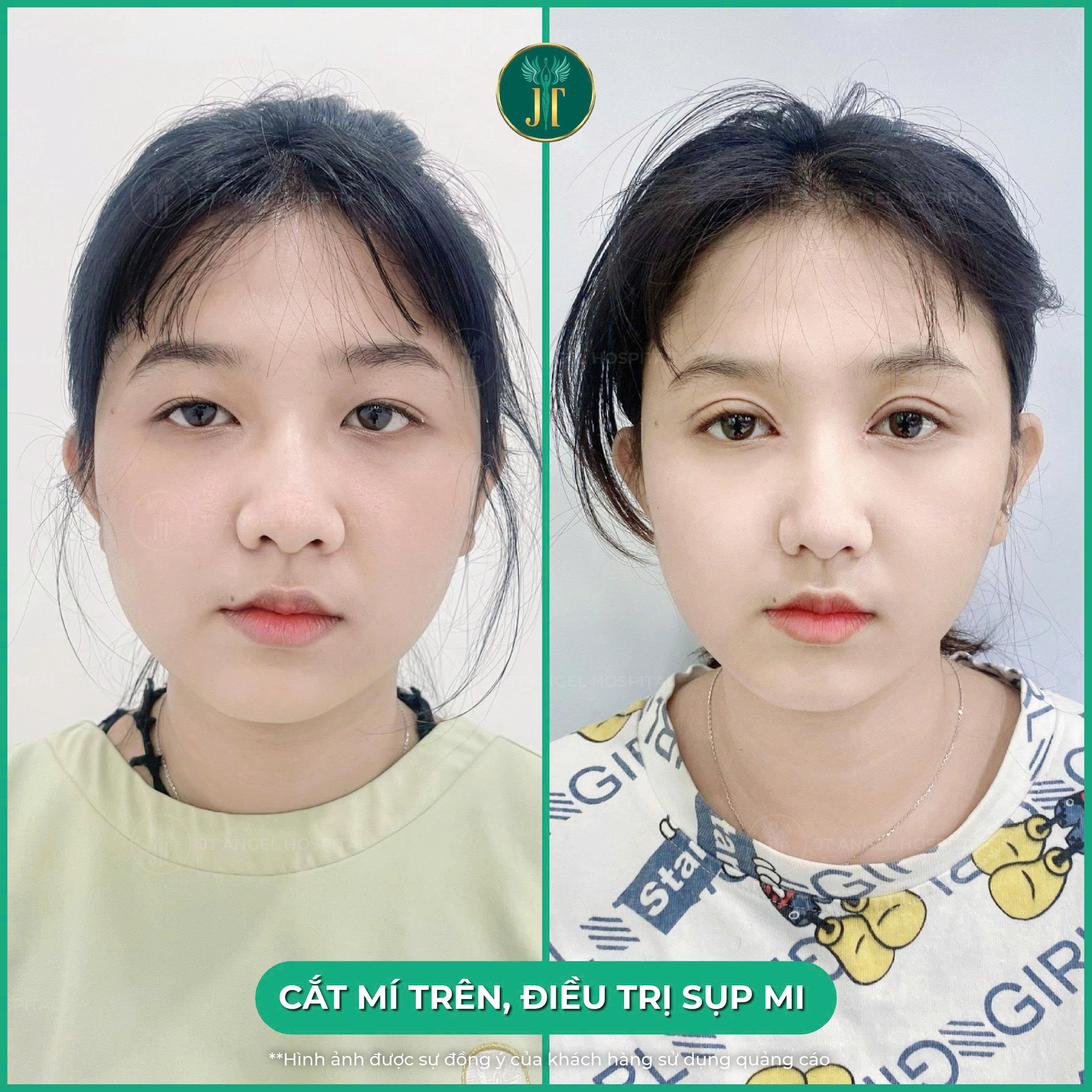 hinh-anh-truoc-sau-dieu-tri-sup-mi-minh-chung-ro-rang-cho-doi-mat-tre-hoa-can-doi-hoan-hao-va-day-suc-song
