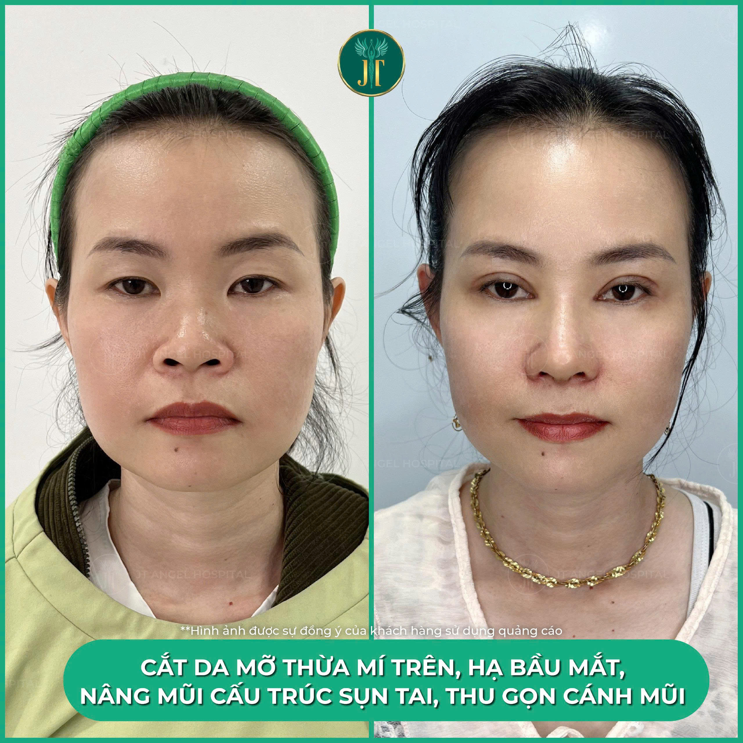 chiem-nguong-hinh-anh-truoc-sau-ha-bau-mat-minh-chung-ro-rang-cho-su-thay-doi-ngoan-muc