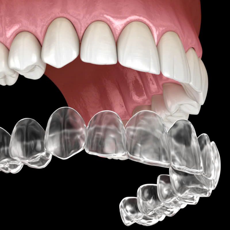 lam-ham-duy-tri-bi-quyet-de-giu-ham-rang-luon-deu-dep-sau-khi-nieng