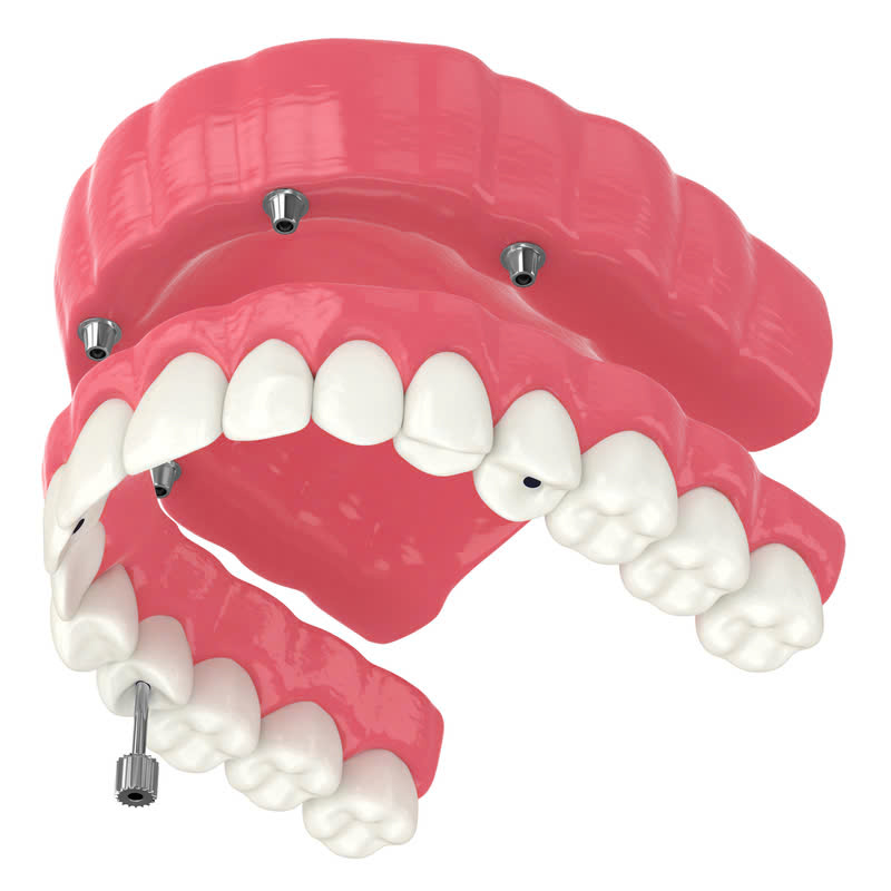 lam-ham-nhua-deo-giai-phap-tiet-kiem-cho-nu-cuoi-rang-ro