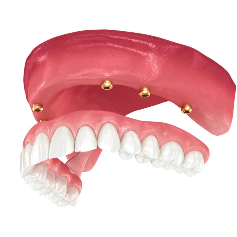 lam-ham-nhua-deo-giai-phap-tiet-kiem-cho-nu-cuoi-rang-ro