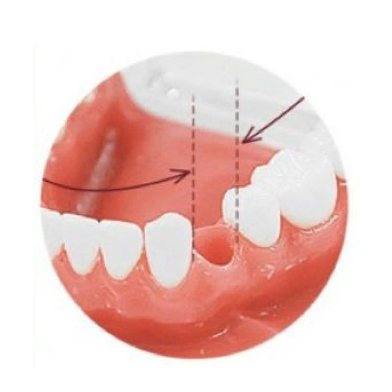 lam-rang-gia-thao-lap-gia-re-chat-luong-cao-giup-ban-tu-tin-trong-giao-tiep-va-phuc-hoi-chuc-nang-an-nhai