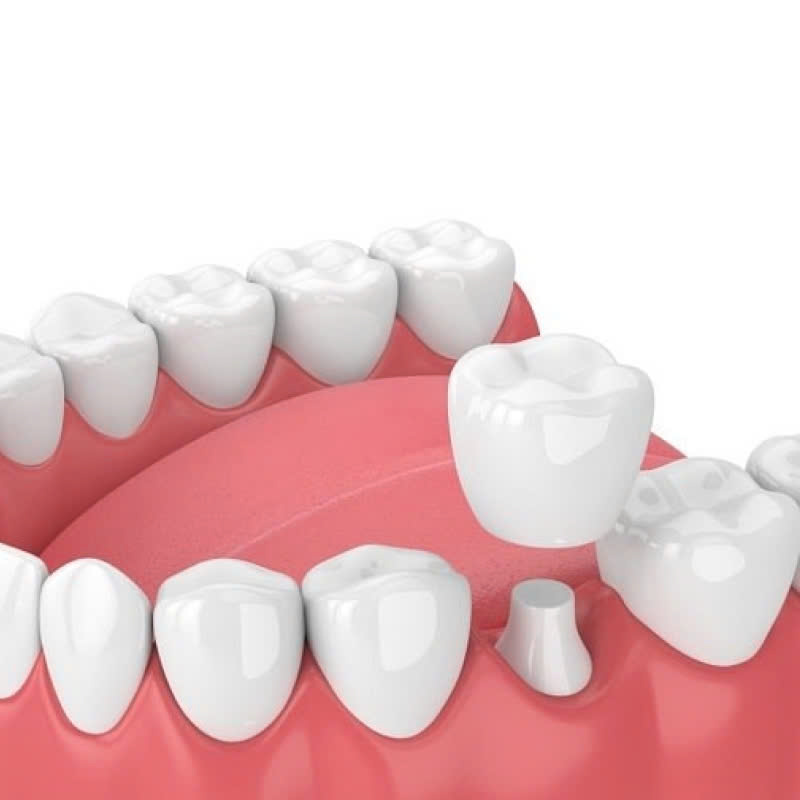 lam-rang-su-cercon-ht-kham-pha-bi-mat-so-huu-ham-rang-trang-sang-hoan-hao-deu-dan