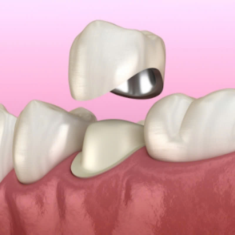 lam-rang-su-cercon-ht-kham-pha-bi-mat-so-huu-ham-rang-trang-sang-hoan-hao-deu-dan