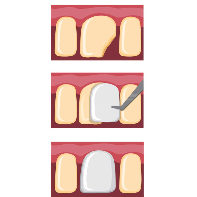 lam-rang-su-ht-smile-giai-phap-hoan-hao-so-huu-nu-cuoi-rang-ro-tu-nhien-thu-hut-moi-anh-nhin