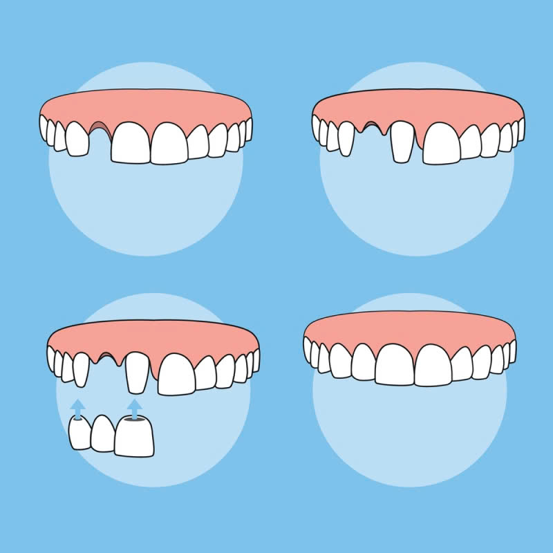 lam-rang-su-ht-smile-giai-phap-hoan-hao-so-huu-nu-cuoi-rang-ro-tu-nhien-thu-hut-moi-anh-nhin