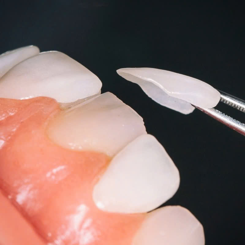 lam-rang-su-lisi-japan-lua-chon-ly-tuong-cho-nu-cuoi-hoan-hao-dep-tu-nhien-nhu-rang-that-va-kha-nang-chiu-luc-tot-thoai-mai-an-nhai