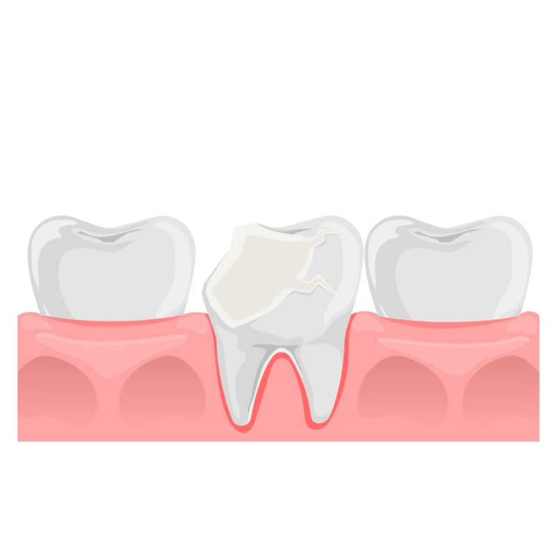 lam-rang-su-lisi-japan-lua-chon-ly-tuong-cho-nu-cuoi-hoan-hao-dep-tu-nhien-nhu-rang-that-va-kha-nang-chiu-luc-tot-thoai-mai-an-nhai