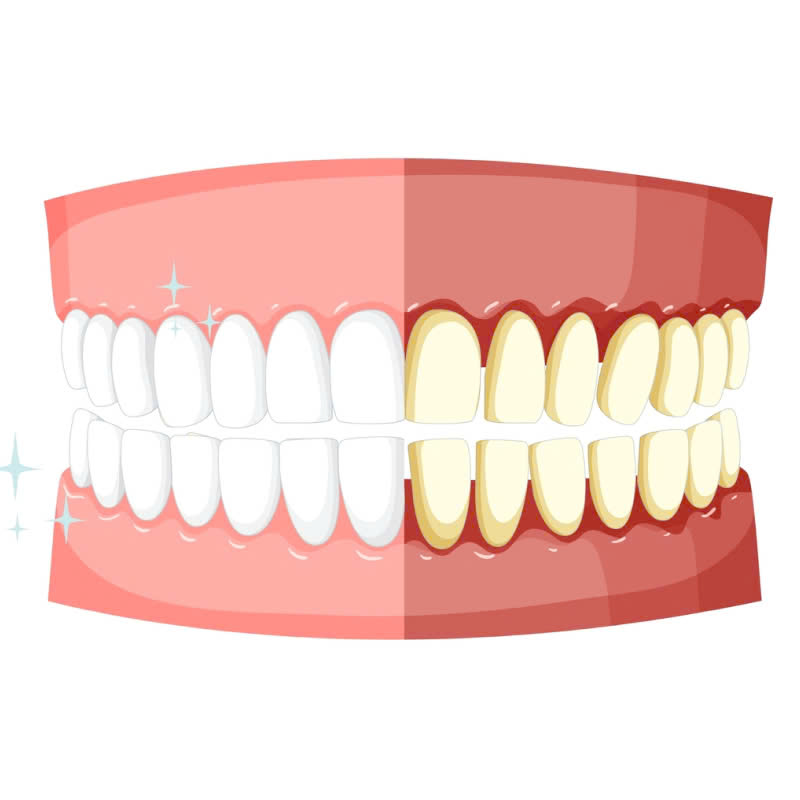 lam-rang-su-lisi-japan-lua-chon-ly-tuong-cho-nu-cuoi-hoan-hao-dep-tu-nhien-nhu-rang-that-va-kha-nang-chiu-luc-tot-thoai-mai-an-nhai