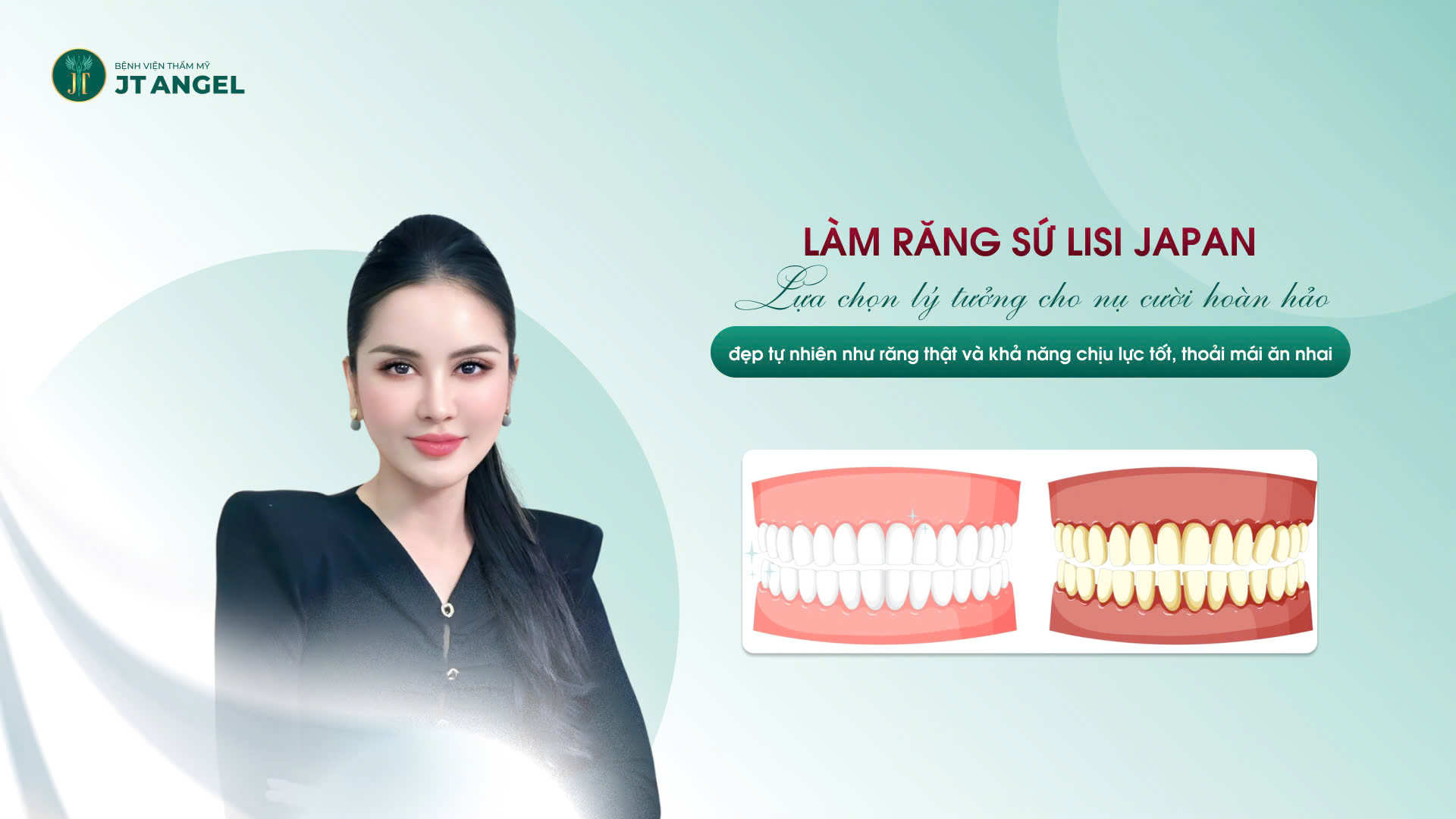 lam-rang-su-lisi-japan-lua-chon-ly-tuong-cho-nu-cuoi-hoan-hao-dep-tu-nhien-nhu-rang-that-va-kha-nang-chiu-luc-tot-thoai-mai-an-nhai