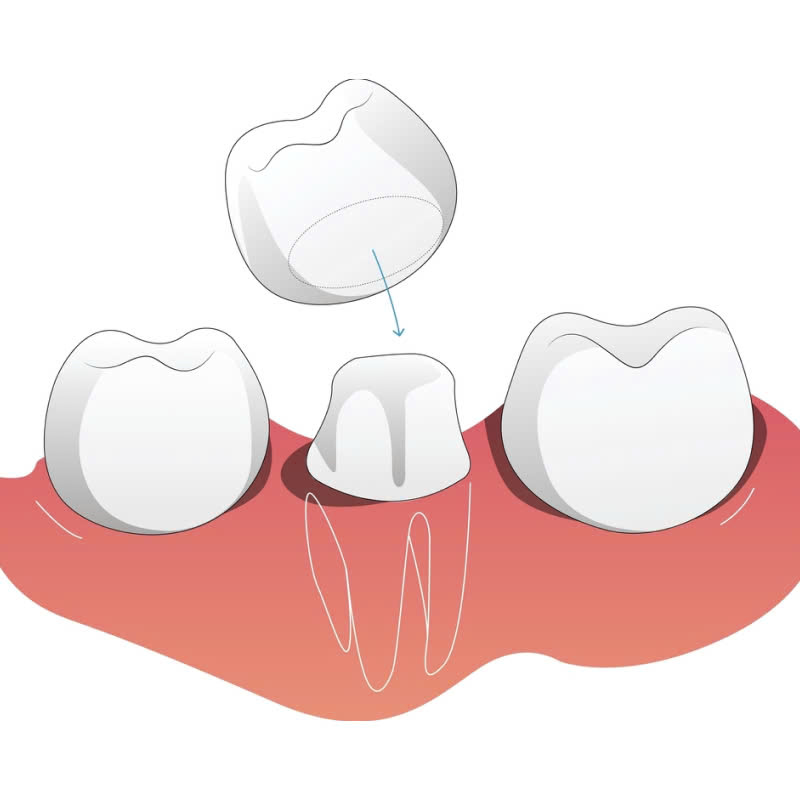 lam-rang-su-vision-cach-de-dang-va-nhanh-chong-giup-ban-so-huu-nu-cuoi-rang-ro