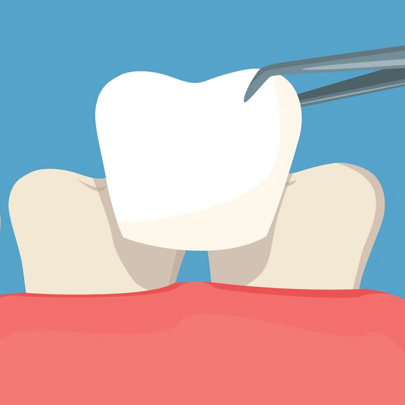 lam-rang-su-vision-cach-de-dang-va-nhanh-chong-giup-ban-so-huu-nu-cuoi-rang-ro