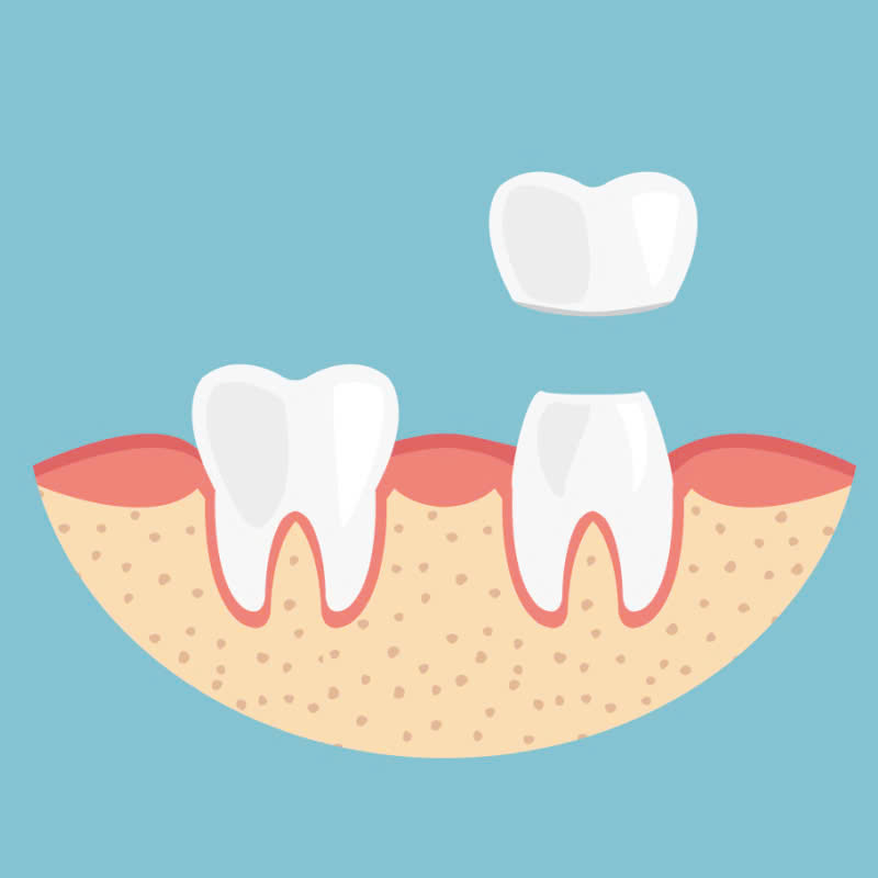 lam-rang-su-vision-cach-de-dang-va-nhanh-chong-giup-ban-so-huu-nu-cuoi-rang-ro