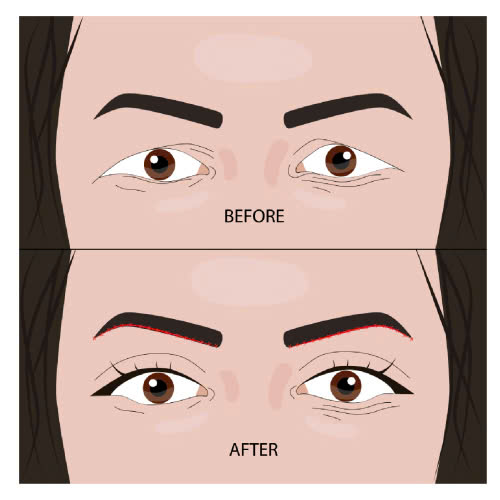 lay-mo-mi-tren-bao-lau-thi-lanh-mach-ban-cac-cach-cham-soc-giup-mi-mau-hoi-phuc-va-on-dinh