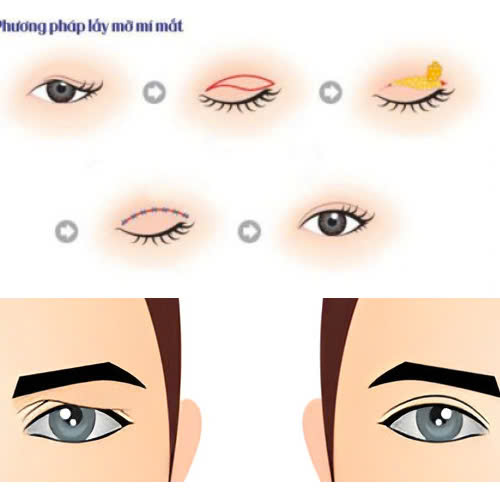 lay-mo-mi-tren-bao-lau-thi-lanh-mach-ban-cac-cach-cham-soc-giup-mi-mau-hoi-phuc-va-on-dinh