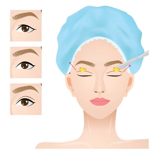 su-that-ve-lay-mo-mi-tren-co-dau-khong-goc-nhin-thuc-te-tu-khach-hang-da-trai-nghiem