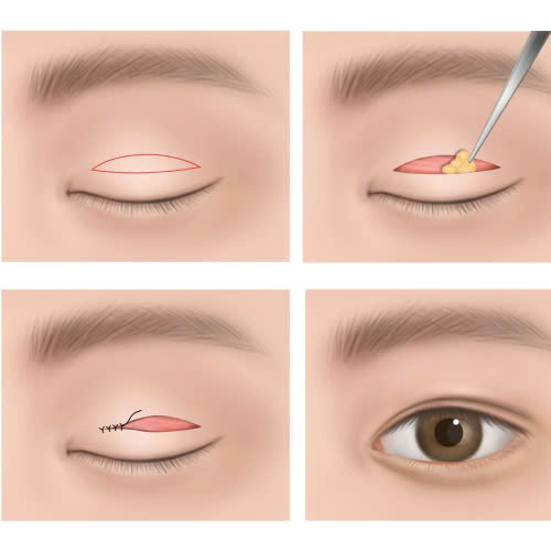 lay-mo-mi-tren-co-nguy-hiem-khong-cung-tim-hieu-chi-tiet-de-ban-yen-tam-truoc-khi-thuc-hien