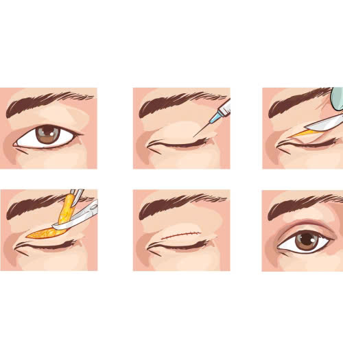 lay-mo-mi-tren-gia-bao-nhieu-tim-hieu-chi-tiet-ve-phuong-phap-tre-hoa-doi-mat-hieu-qua