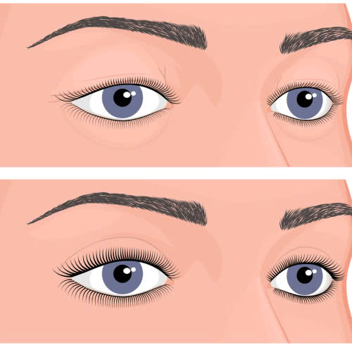 lay-mo-mi-tren-gia-bao-nhieu-tim-hieu-chi-tiet-ve-phuong-phap-tre-hoa-doi-mat-hieu-qua