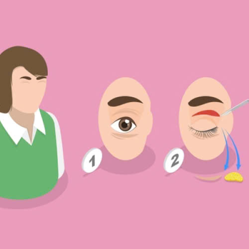 lay-mo-mi-tren-gia-bao-nhieu-tim-hieu-chi-tiet-ve-phuong-phap-tre-hoa-doi-mat-hieu-qua