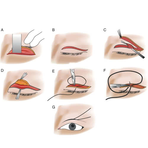 lay-mo-mi-tren-giu-duoc-bao-lau-giai-dap-chi-tiet-nhung-yeu-to-anh-huong-den-thoi-gian-giu-hieu-qua-sau-khi-thuc-hien