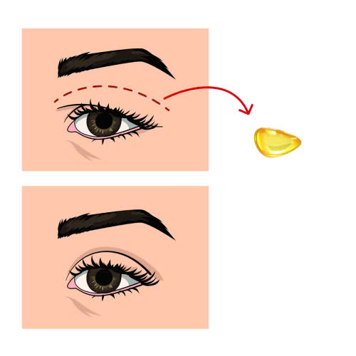 lay-mo-mi-tren-giu-duoc-bao-lau-giai-dap-chi-tiet-nhung-yeu-to-anh-huong-den-thoi-gian-giu-hieu-qua-sau-khi-thuc-hien