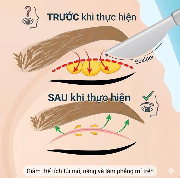 lay-mo-mi-tren-ket-hop-cat-mi-bi-quyet-giup-doi-mat-tre-trung-rang-ro-tu-nhien-cho-phai-dep-hien-nay