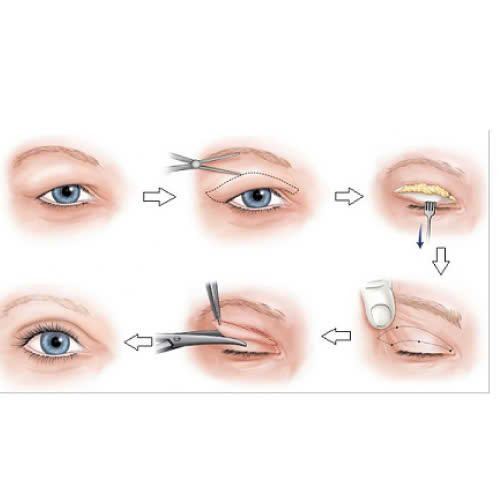 lay-mo-mi-tren-la-gi-quy-trinh-uu-diem-va-nhung-dieu-can-biet-truoc-khi-phau-thuat