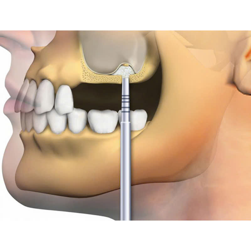 nang-xoang-ho-la-gi-khi-nao-thi-nen-thuc-hien-phuong-phap-nay