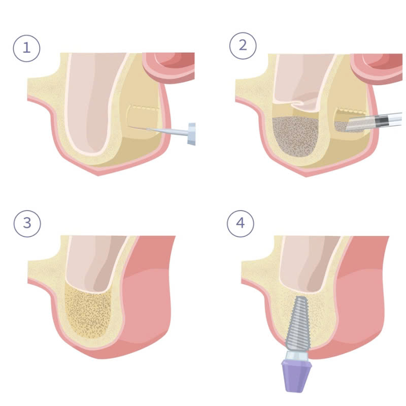 nang-xoang-ho-la-gi-khi-nao-thi-nen-thuc-hien-phuong-phap-nay
