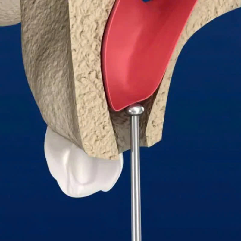 nang-xoang-ho-la-gi-khi-nao-thi-nen-thuc-hien-phuong-phap-nay