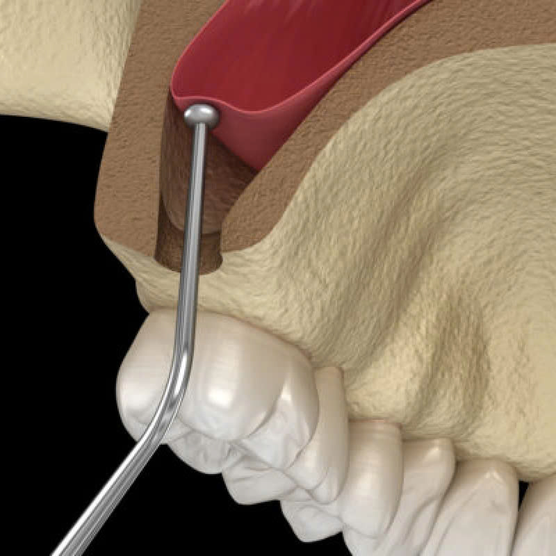 nang-xoang-kin-la-gi-loi-ich-cua-nang-xoang-kin-trong-phau-thuat-nha-khoa
