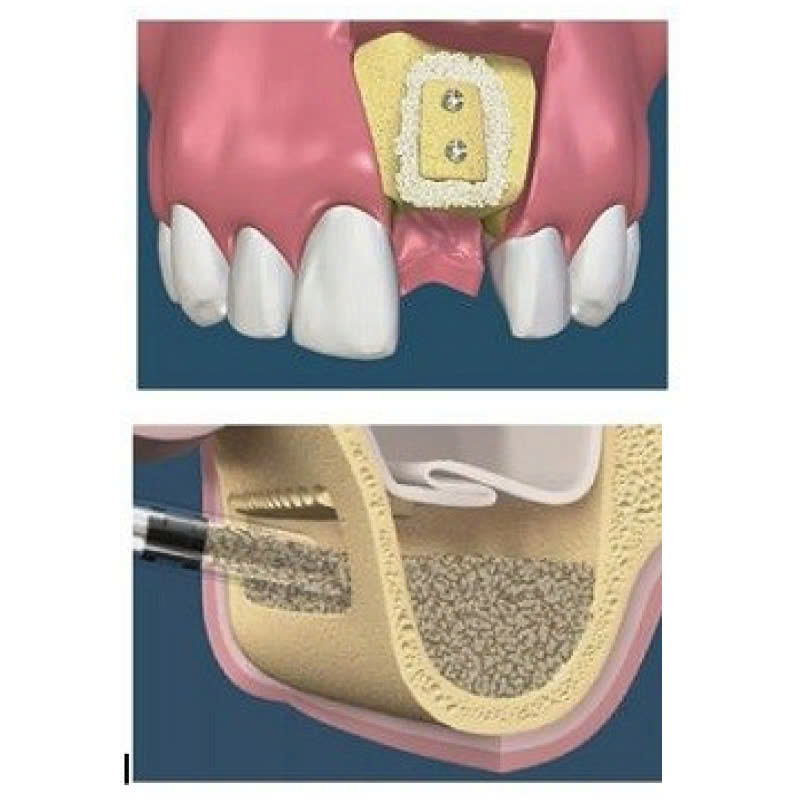 nang-xoang-kin-la-gi-loi-ich-cua-nang-xoang-kin-trong-phau-thuat-nha-khoa