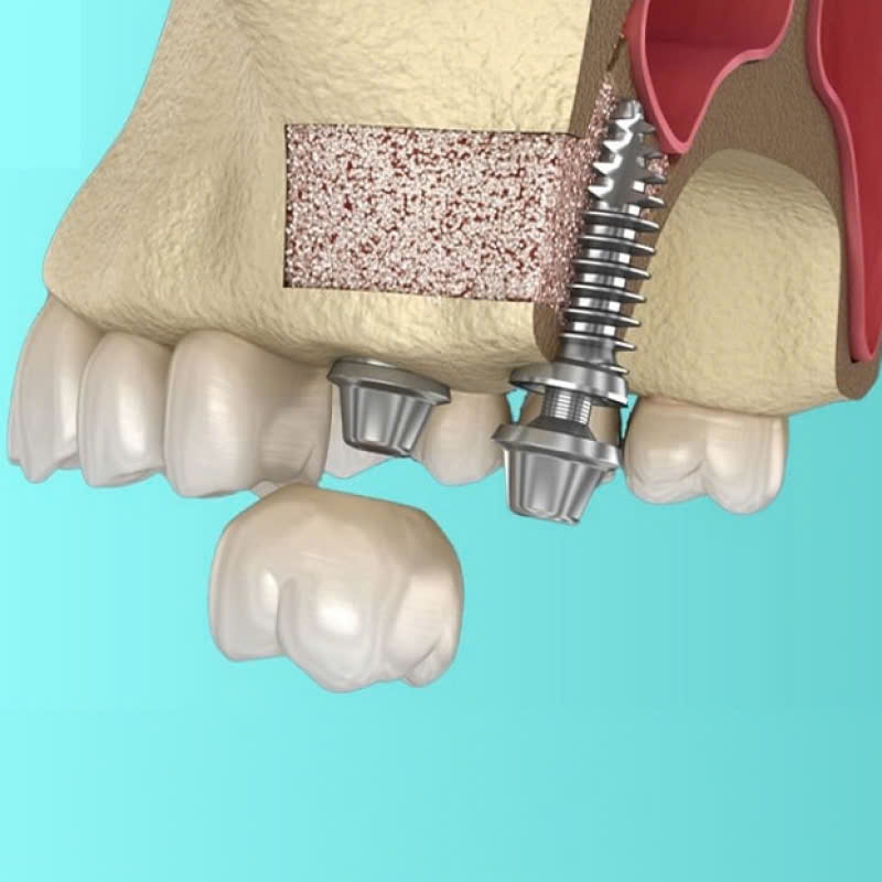 nang-xoang-kin-la-gi-loi-ich-cua-nang-xoang-kin-trong-phau-thuat-nha-khoa