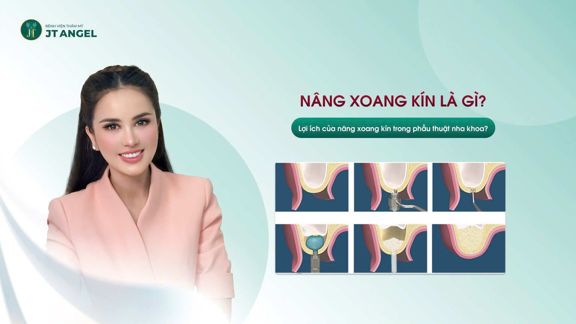 nang-xoang-kin-la-gi-loi-ich-cua-nang-xoang-kin-trong-phau-thuat-nha-khoa