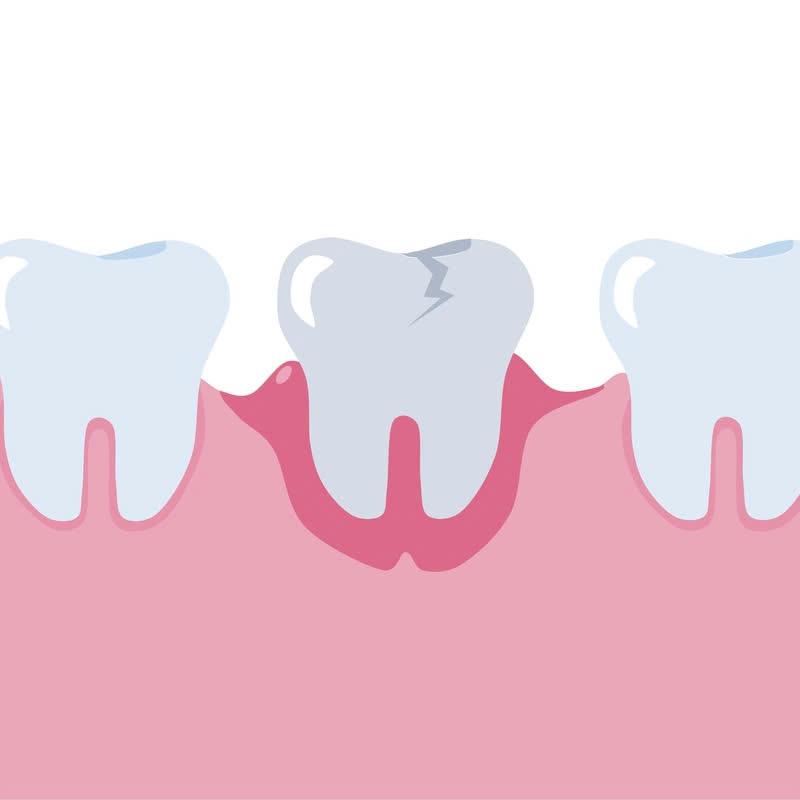 nao-tui-nha-chu-giai-phap-lam-sach-phan-mo-mem-bi-viem-o-mat-ngoai-nuou-rang-khac-phuc-benh-viem-nha-chu-bao-ve-suc-khoe-rang-mieng