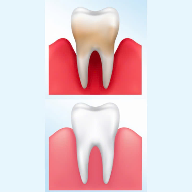 nao-tui-nha-chu-giai-phap-lam-sach-phan-mo-mem-bi-viem-o-mat-ngoai-nuou-rang-khac-phuc-benh-viem-nha-chu-bao-ve-suc-khoe-rang-mieng