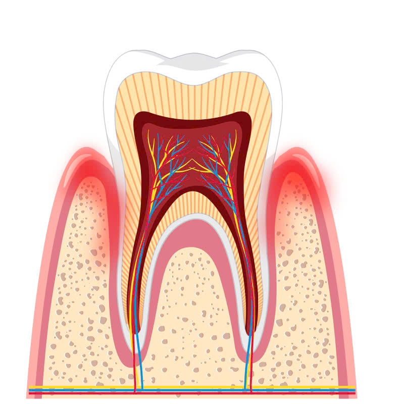 nao-tui-nha-chu-giai-phap-lam-sach-phan-mo-mem-bi-viem-o-mat-ngoai-nuou-rang-khac-phuc-benh-viem-nha-chu-bao-ve-suc-khoe-rang-mieng
