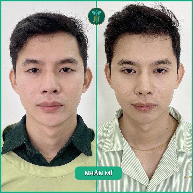nhan-mi-bao-lau-thi-cat-chi-cung-giai-dap-chi-tiet-qua-trinh-hoi-phuc-va-cach-cham-soc-cho-nguoi-moi-nhan-mi