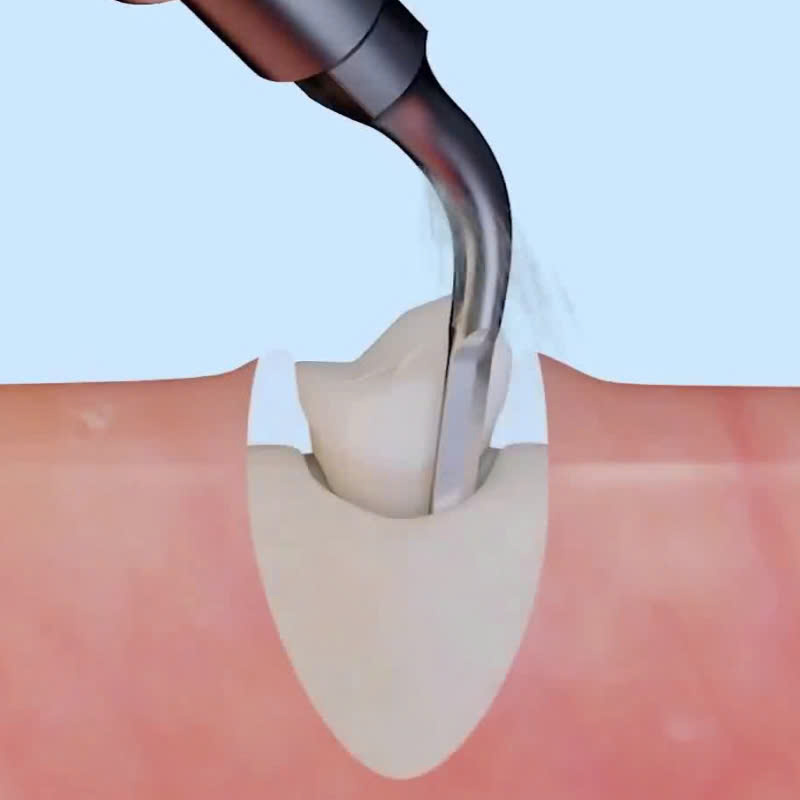 nho-rang-bang-may-piezotome-co-an-toan-khong-nhung-dieu-luu-y-truoc-khi-thuc-hien-dich-vu