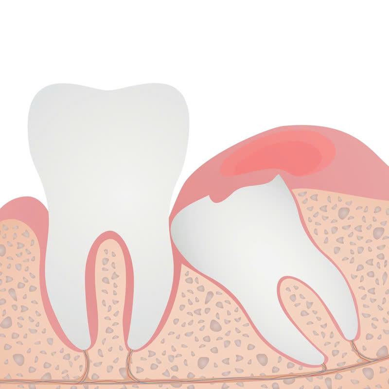 nho-rang-bang-may-piezotome-co-an-toan-khong-nhung-dieu-luu-y-truoc-khi-thuc-hien-dich-vu