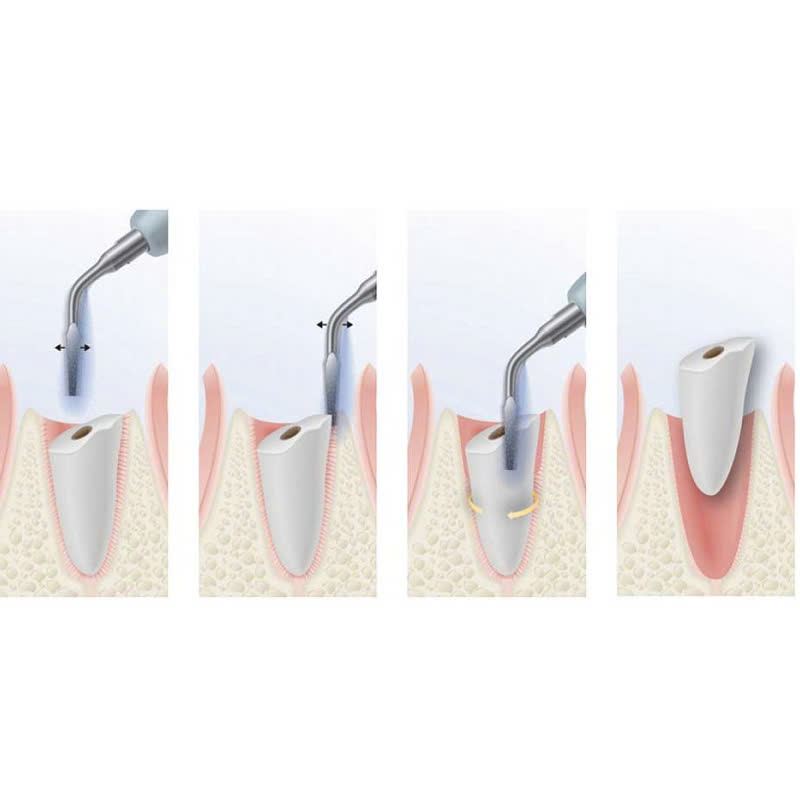 nho-rang-bang-may-piezotome-co-an-toan-khong-nhung-dieu-luu-y-truoc-khi-thuc-hien-dich-vu