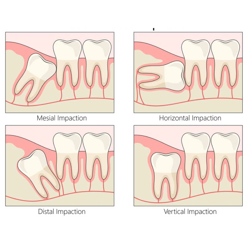 nho-rang-khon-co-nguy-hiem-khong-nhung-luu-y-ban-can-nam-truoc-khi-thuc-hien