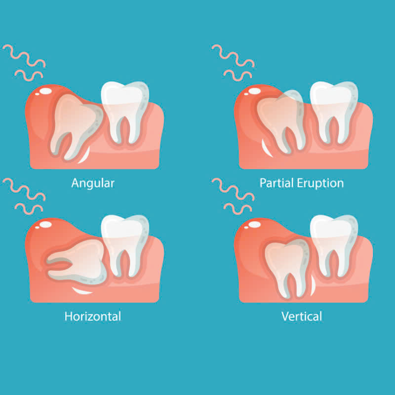 nho-rang-khon-co-nguy-hiem-khong-nhung-luu-y-ban-can-nam-truoc-khi-thuc-hien
