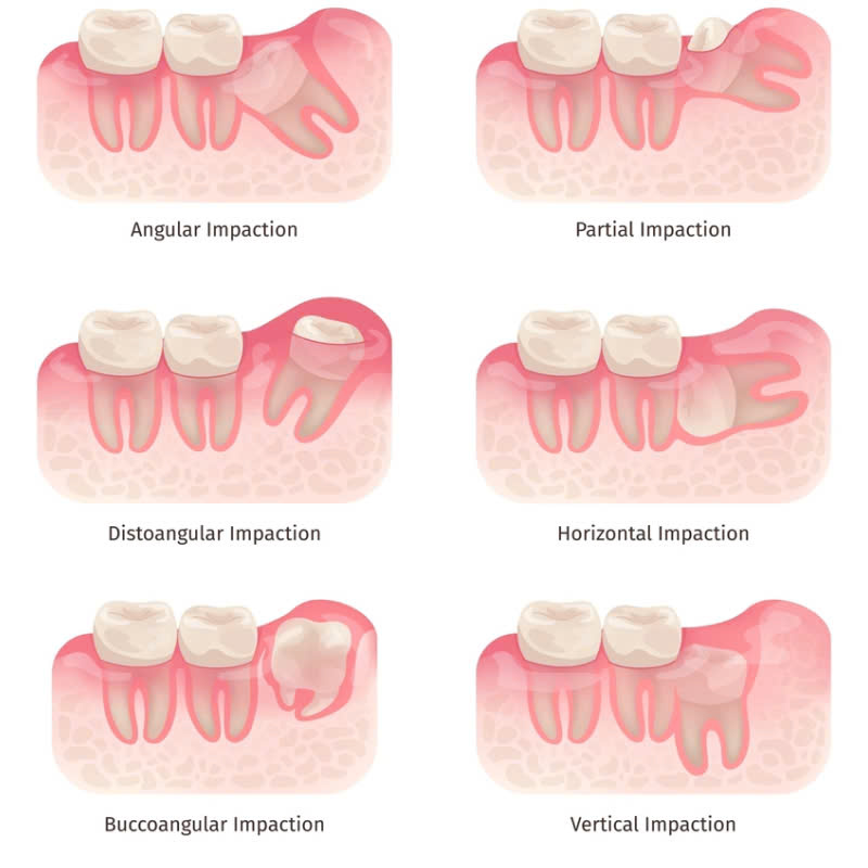 nho-rang-khon-co-nguy-hiem-khong-nhung-luu-y-ban-can-nam-truoc-khi-thuc-hien