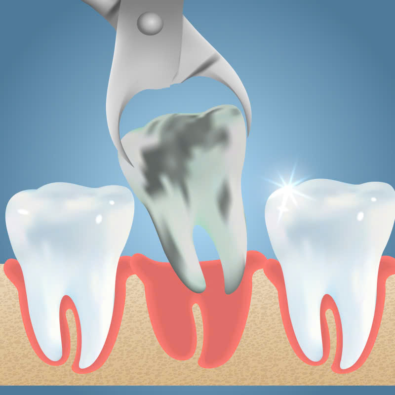 nho-rang-thuong-qua-trinh-nhanh-chong-khong-dau-nhu-ban-nghi