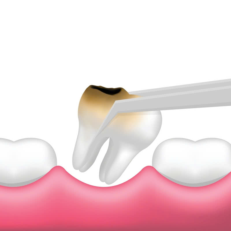 nho-rang-thuong-qua-trinh-nhanh-chong-khong-dau-nhu-ban-nghi