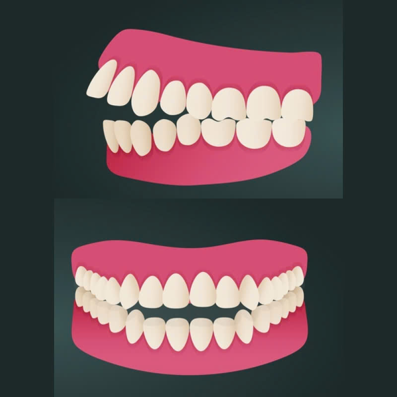 nieng-rang-bang-mac-cai-kim-loai-vuot-qua-tu-ti-vi-rang-ho-mom-ham-rang-khong-deu