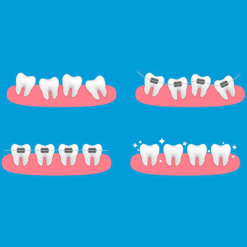 nieng-rang-bang-mac-cai-kim-loai-vuot-qua-tu-ti-vi-rang-ho-mom-ham-rang-khong-deu